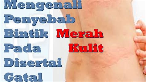 luti luti air|Ini 5 Penyebab Gatal Berair Pada Kulit dan Cara Mengatasinya